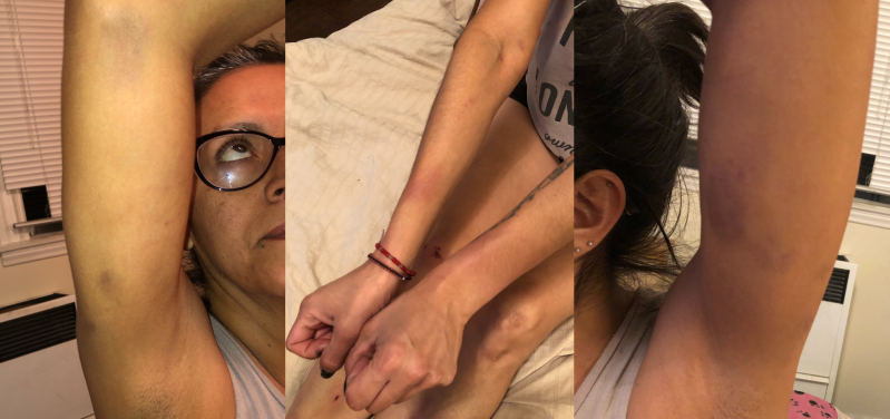 Liliana Cortez with some of the injuries she sustained after being tackled to the ground by officers from USC's Department of Public Safety after she hugged a tree on a sorority's front lawn. She sustained bruising on her arms, shoulders, back, ribs, thighs, knees, calves, and wrists. The photos were taken the night she was released from jail. Images courtesy Liliana Cortez